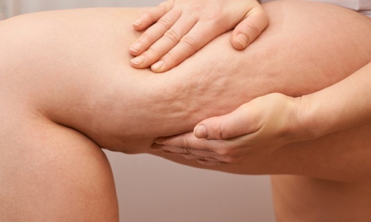 Zwei Hände halten ein Bein mit von Cellulite betroffener Haut